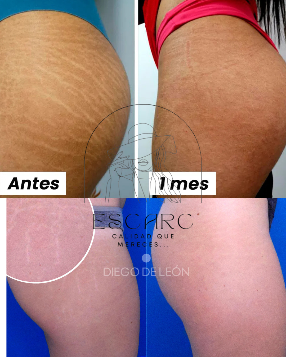 CIARA: Suero líquido para las estrías